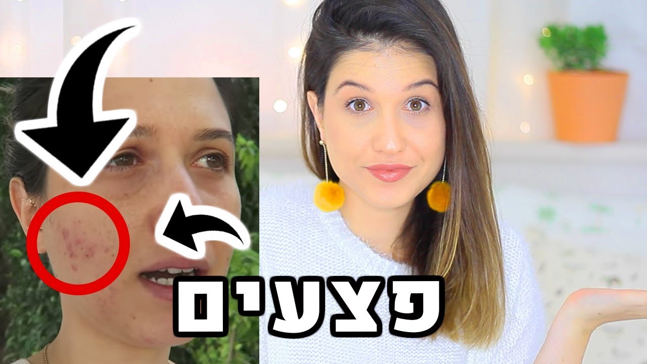 איך העלמתי את כל החצ׳קונים שלי? במה אני משתמשת היום לפצעונים? הכל על הפנים שלי!
