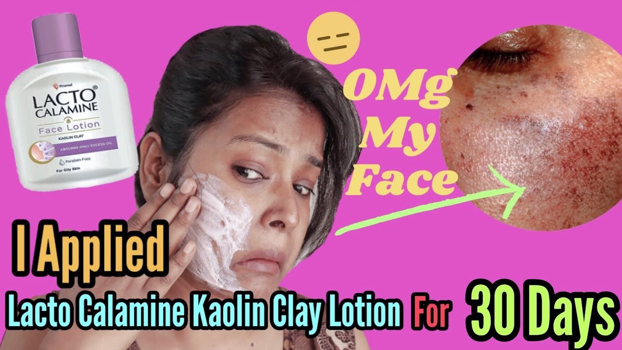 LIVE RESULT I Applied LACTO CALAMINE KAOLIN CLAY FACE LOTION For 30 Days | Shinny Roops
