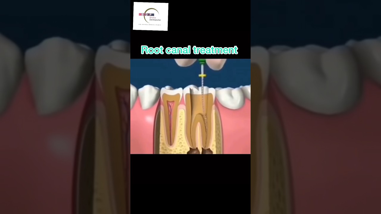 Root Canal Treatment and Post & Core for decayed tooth #pain #tooth #dentist