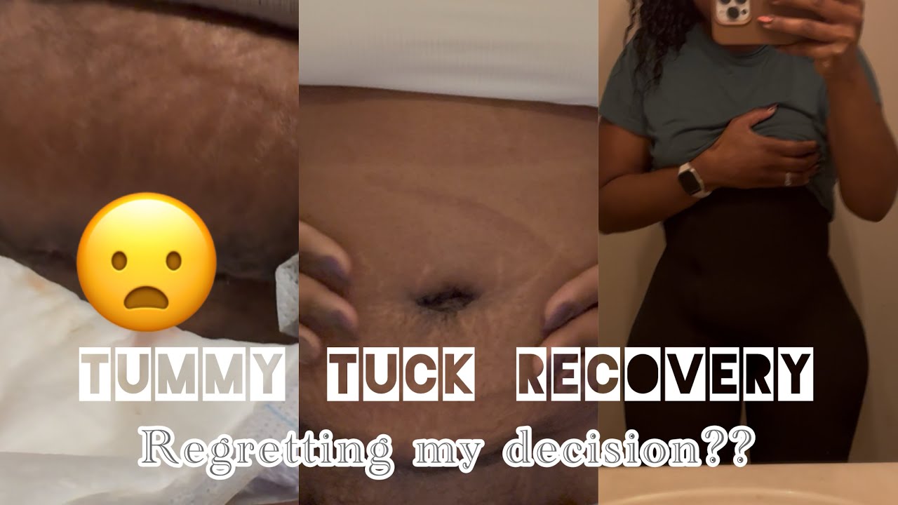 Would I Do This Again?? : Tummy Tuck Recovery : Part 4