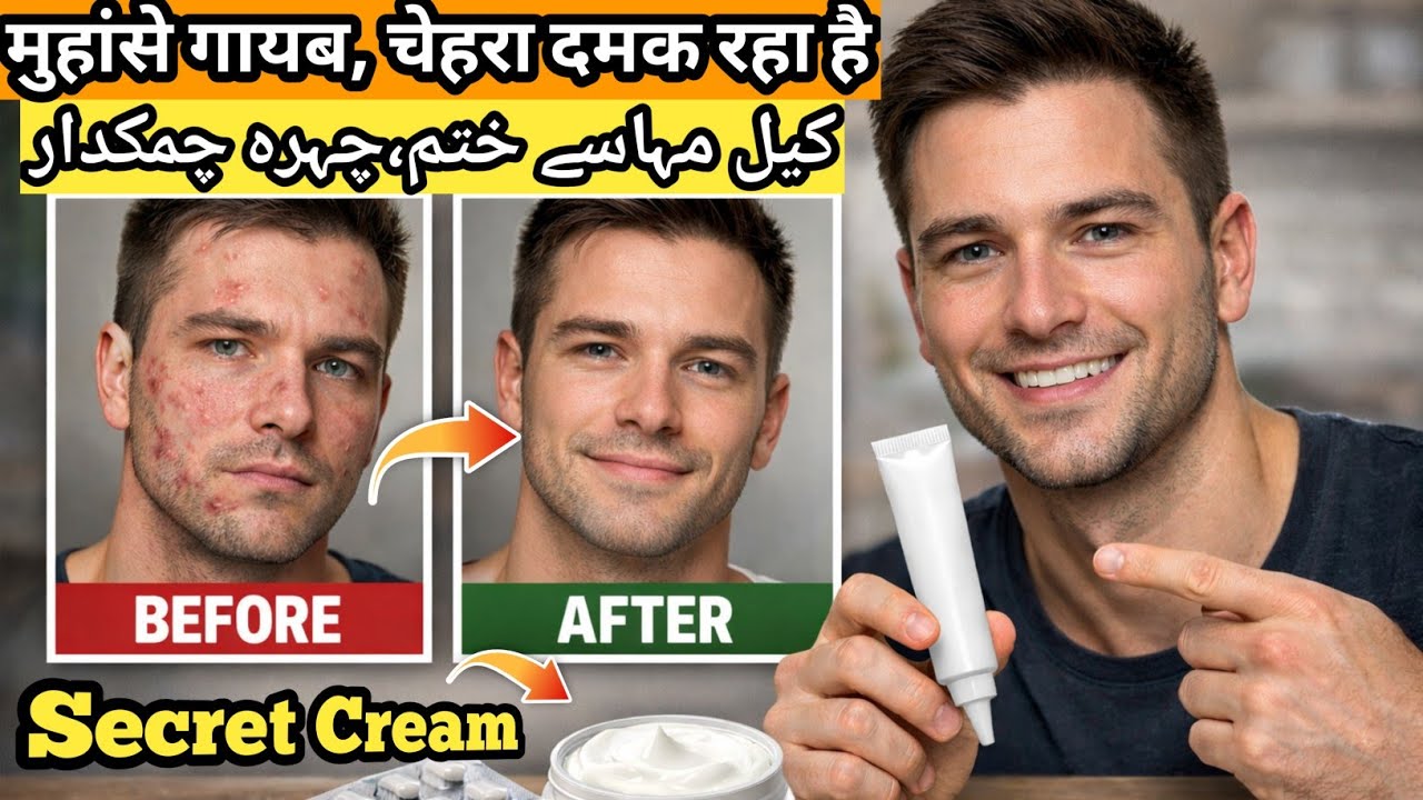 Secret Cream to Remove Acne Pimple Dark Spots | Get Glowing Skin 💯