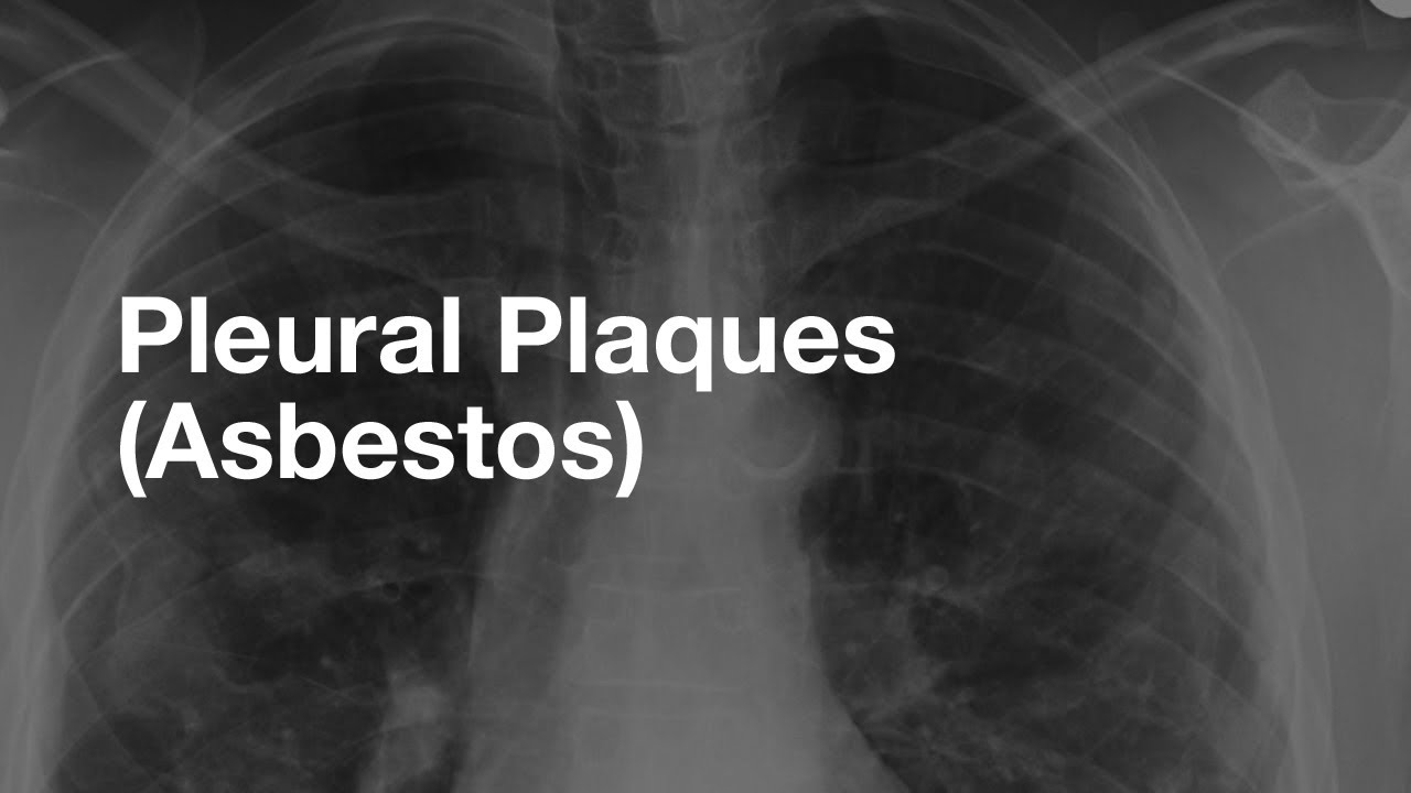 Asbestos-Related Pleural Plaques