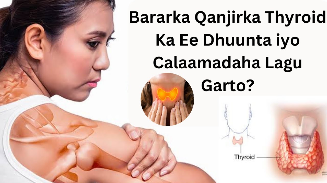 Bararka qanjirka thyroid ka ee dhuunta iyo calaamadaha lagu garto | @Drabdiaziz