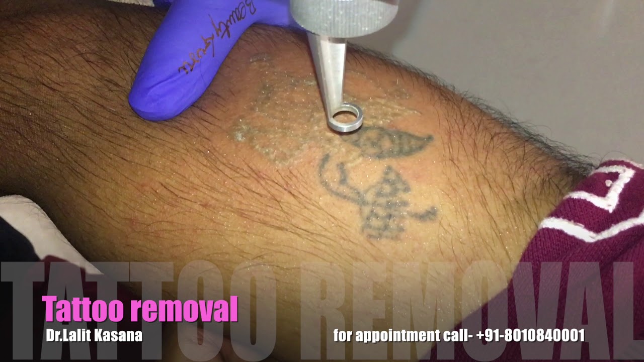 TATTOO REOVAL with LASER by DR.LALIT KASANA