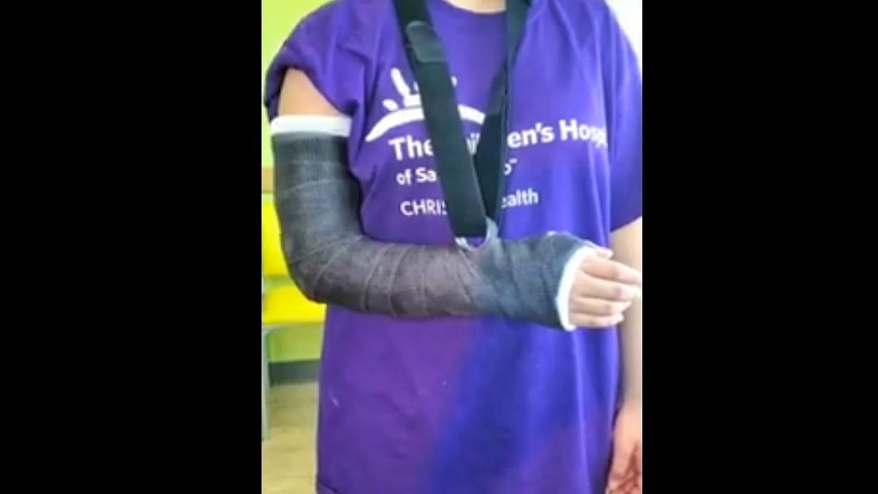 How to Make a Hanging Long Arm Cast, (fiberglass)