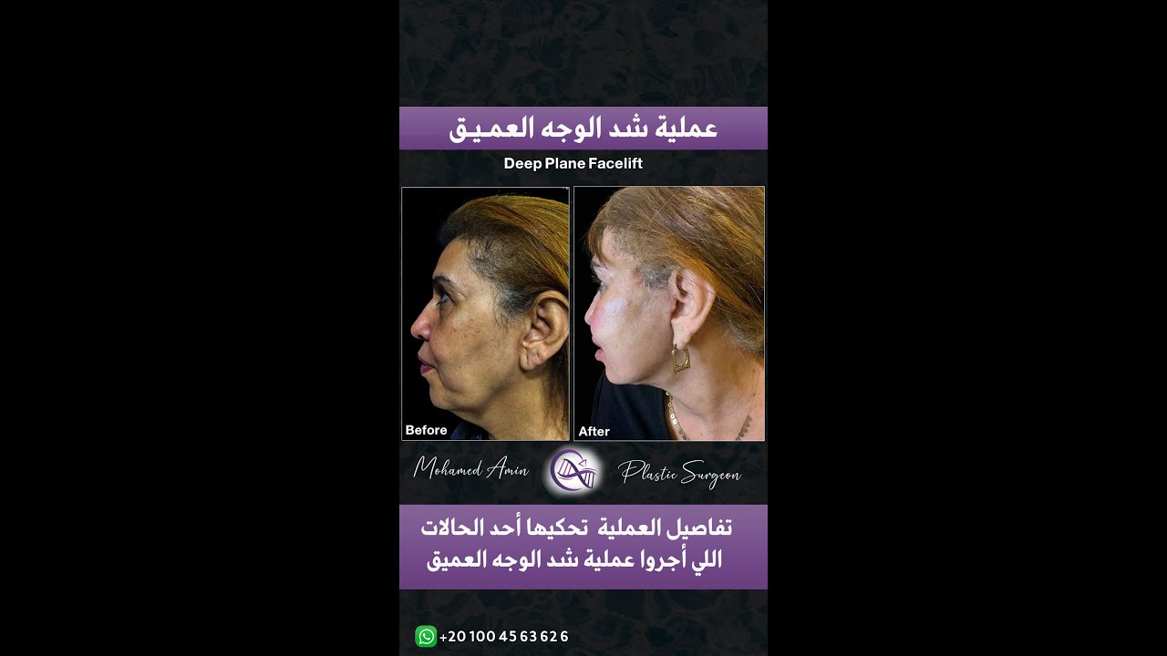 عملية شد الوجه والرقبه العميق | تفاصيل تحكيها أحد السيدات اللي أجرو العملية .