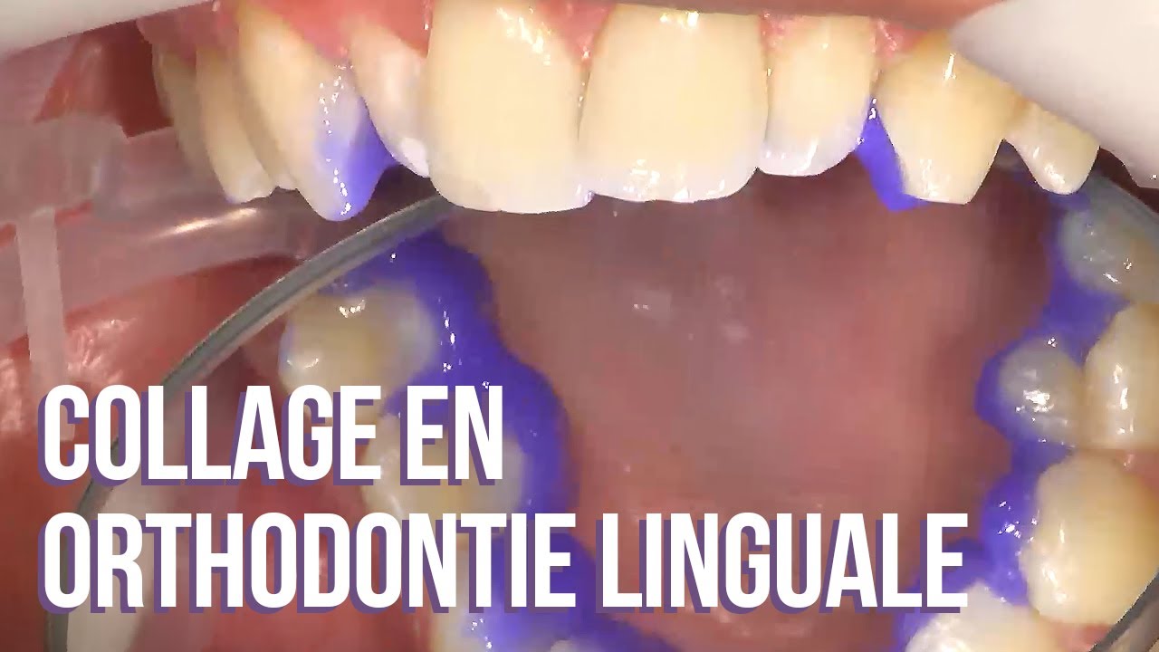 😛 Collage en orthodontie linguale