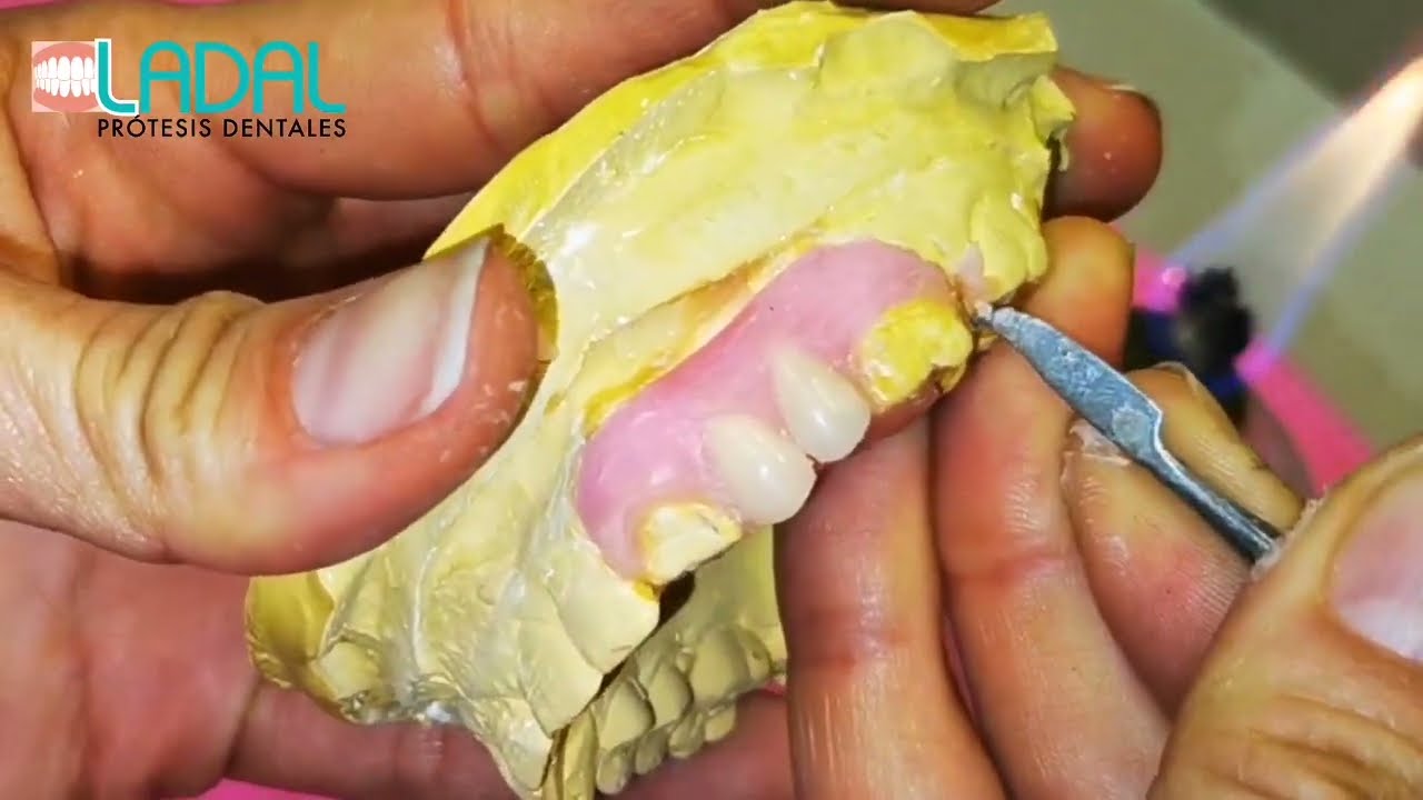 Encerado de Prótesis  dental flexible unilateral #2
