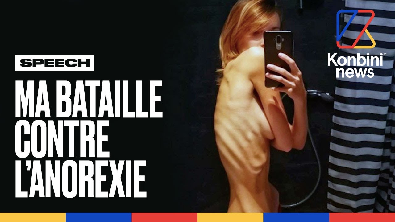 &Agrave; 20 ans, elle ne pesait plus que 33 kilos. Manon raconte sa bataille contre l'anorexie | Konbini