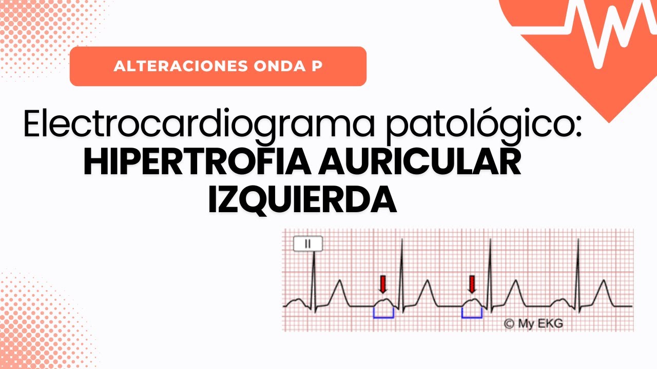 Electrocardiograma Patológico: HIPERTROFIA AURICULAR IZQUIERDA