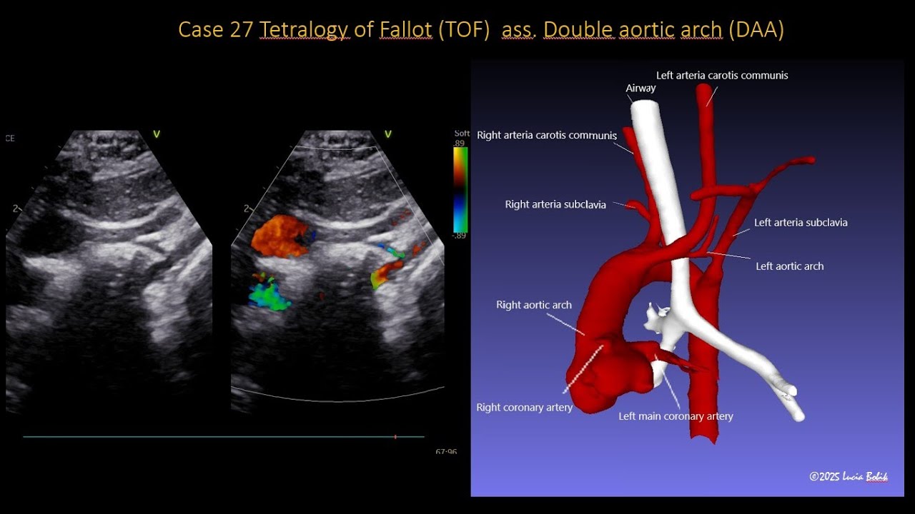 Case 27 Tetralogy of Fallot ass  Double aortic arch