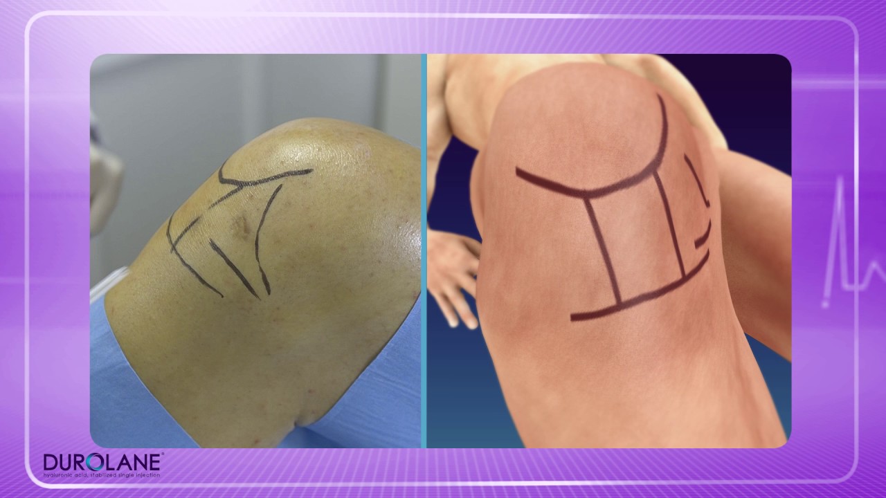 INFILTRACION EN  RODILLA PORTAL MEDIAL