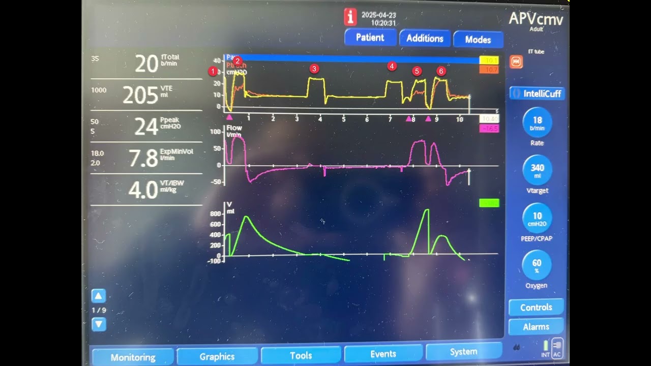 A case of Dyssynchrony with the Ventilator