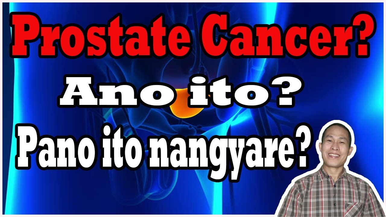 Prostate Cancer? Ano ito? Paano ito nag simula?