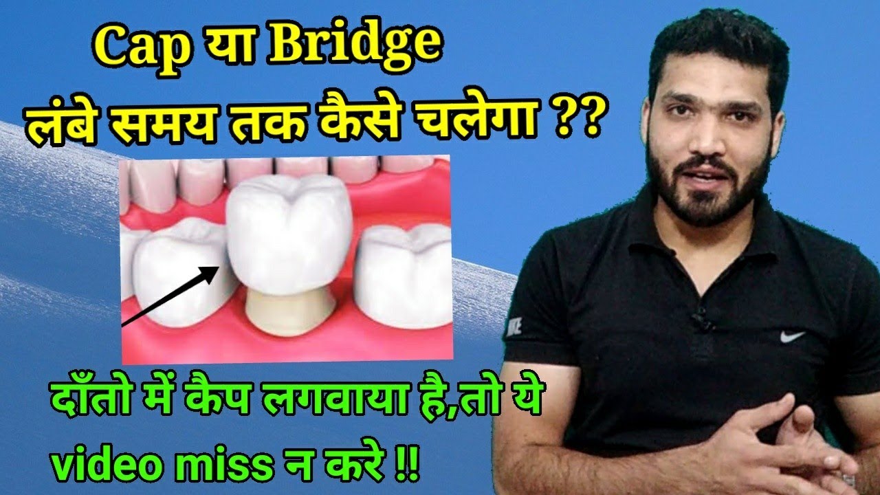 Tooth cap लगवाने के बाद क्या करे जिससे हमेशा अच्छा रहे ?? Precautions for tooth cap and Bridge