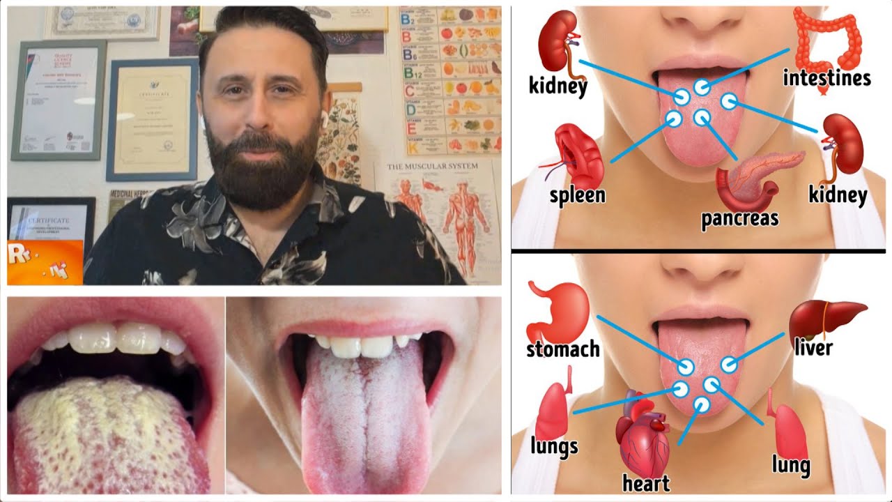 KUJDES! Ngjyra dhe forma e GJUHËS paralajmërojnë sëmundje të fshehta