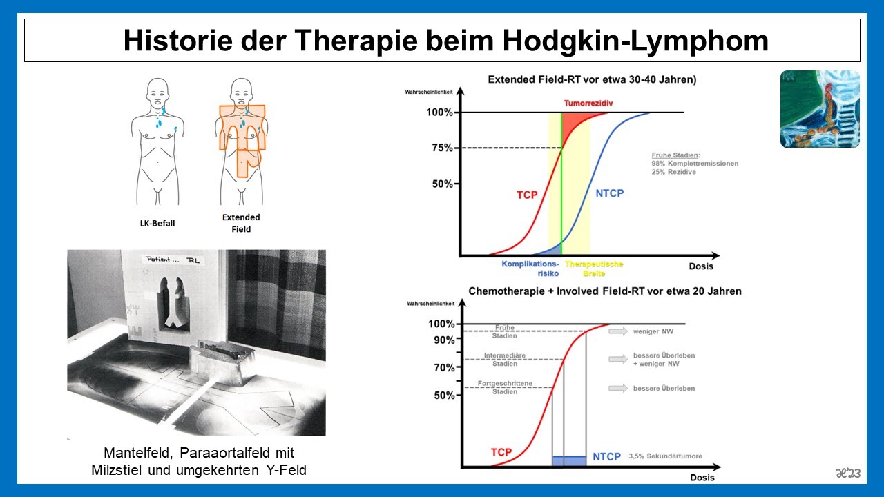 Historie der Therapie beim Hodgkin Lymphom | Strahlentherapie Prof. Hilke Vorwerk