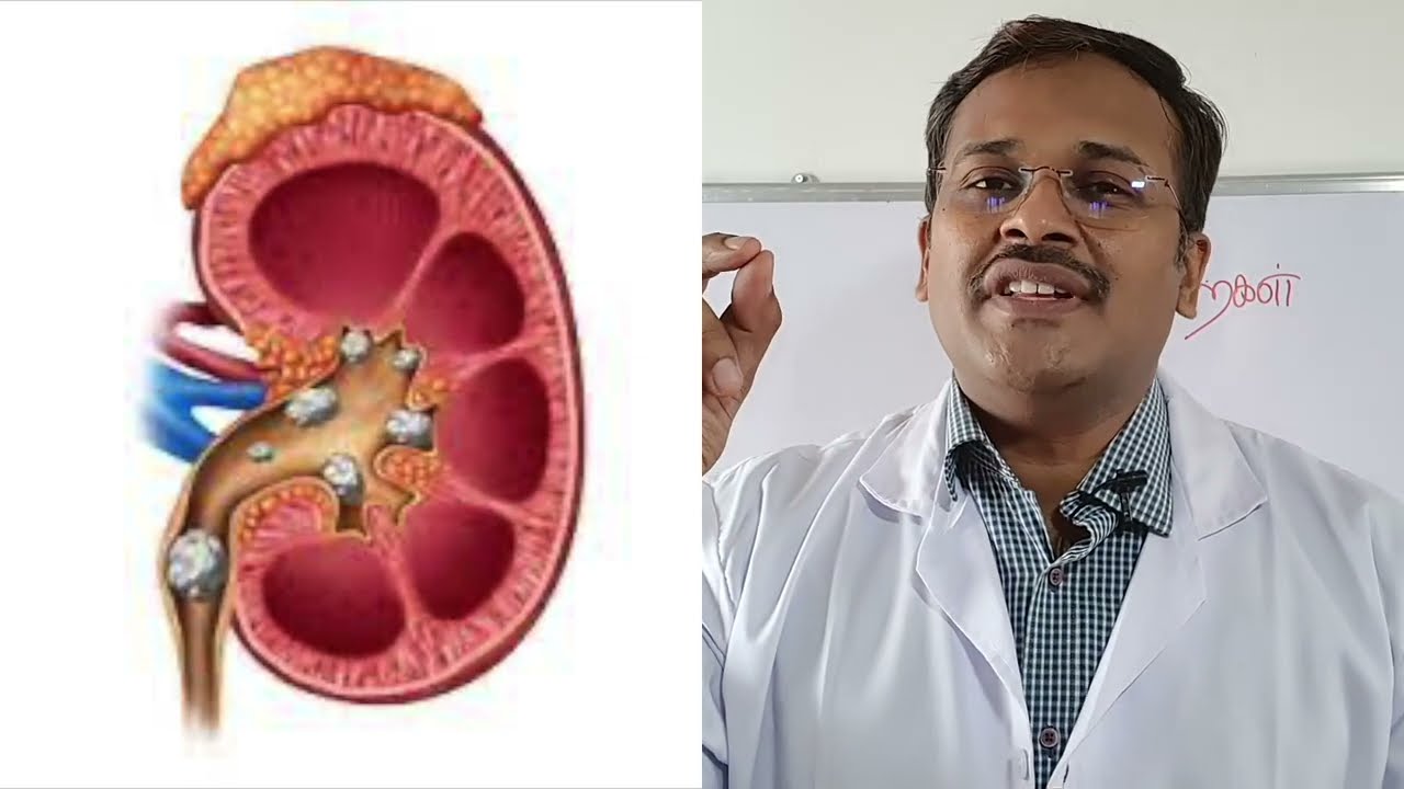 கிட்னி கல் மருத்துவம் - kidney stones: foods and home remedies in tamil - dr karthikeyan