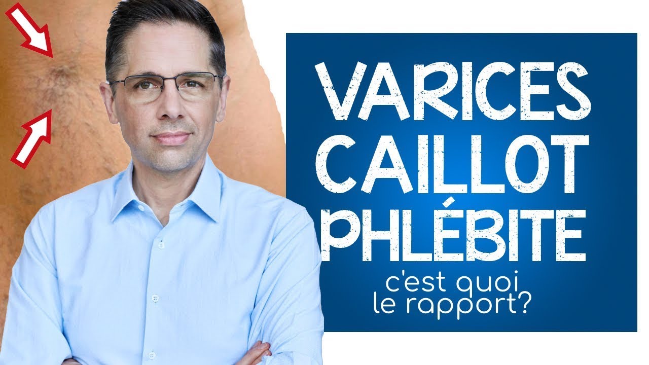 Varices, caillot et phlébite: c'est quoi le rapport ?