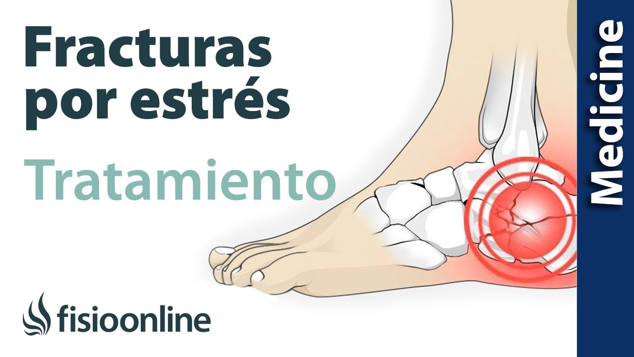 Fracturas por estrés en el deporte: síntomas, diagnóstico y tratamiento