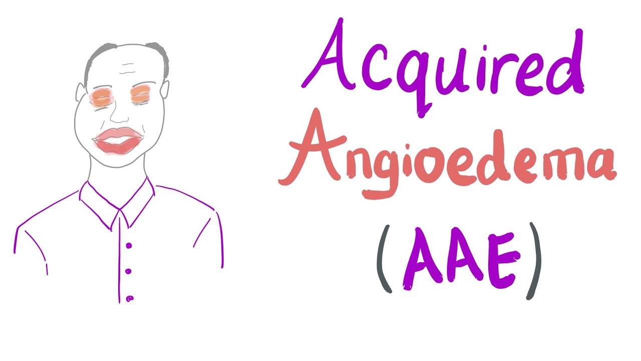 Acquired Angioedema (AAE)