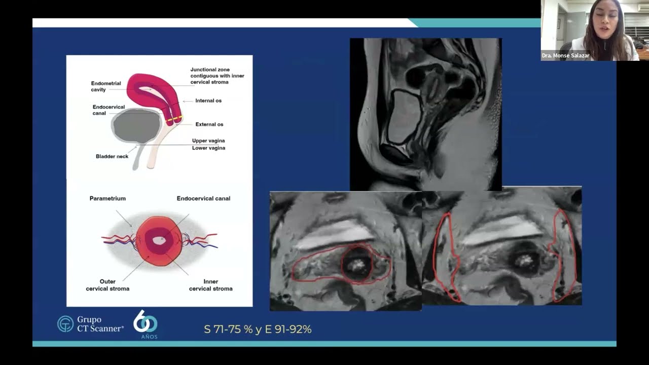 Cáncer Cervicouterino: La Imagen como ruta hacia el diagnóstico preciso.