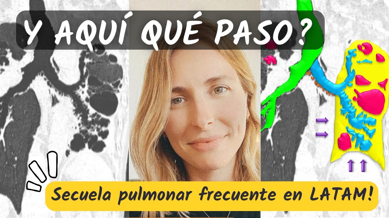 ¿Qué pasó aquí? 😮 ¡Secuela pulmonar frecuente en LATAM!