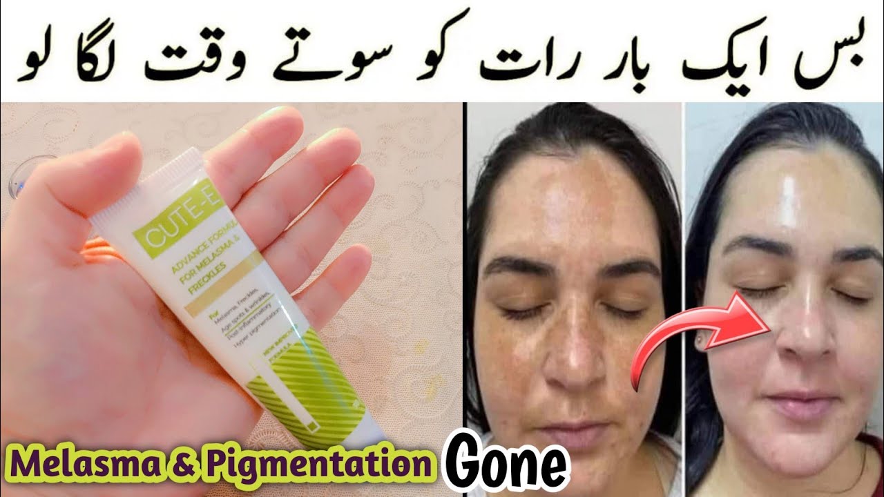 The Best Treatment For Melasma || Remove Open Pores & Hyperpigmentation