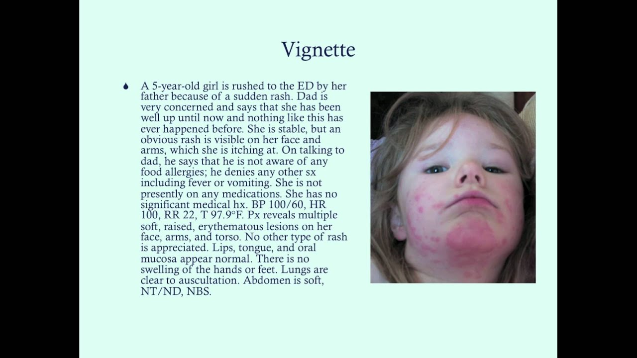 Food Allergy - CRASH! Medical Review Series