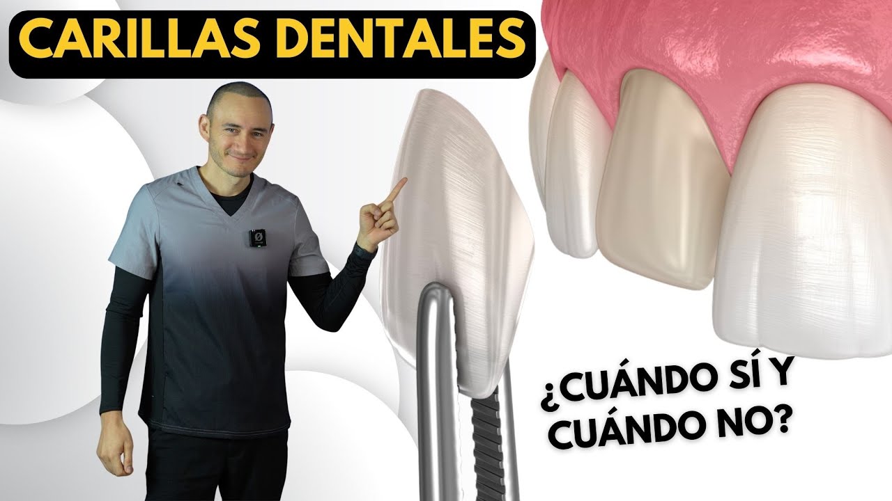 Carillas dentales de porcelana | Indicaciones y contraindicaciones