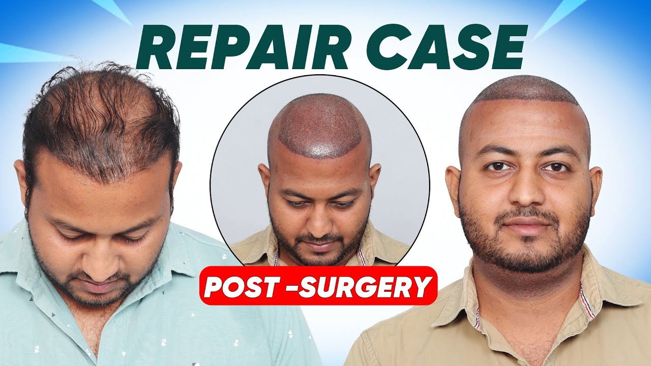 Hair Transplant in Chennai (HX-UCWA) | Best Results & Cost of Hair Transplant in Chennai