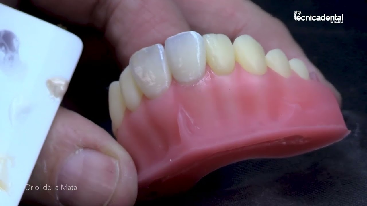 Maquillaje Dental: Profundidad, Translucidez y Naturalidad en Capas, Oriol de la Mata