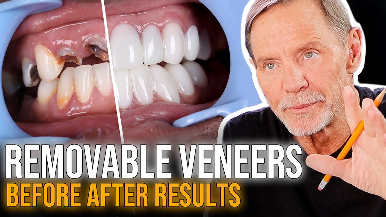 Cosmetic Smile Makeover See Before & After Pictures, Removable Dental Veneers by Brighter Image Lab