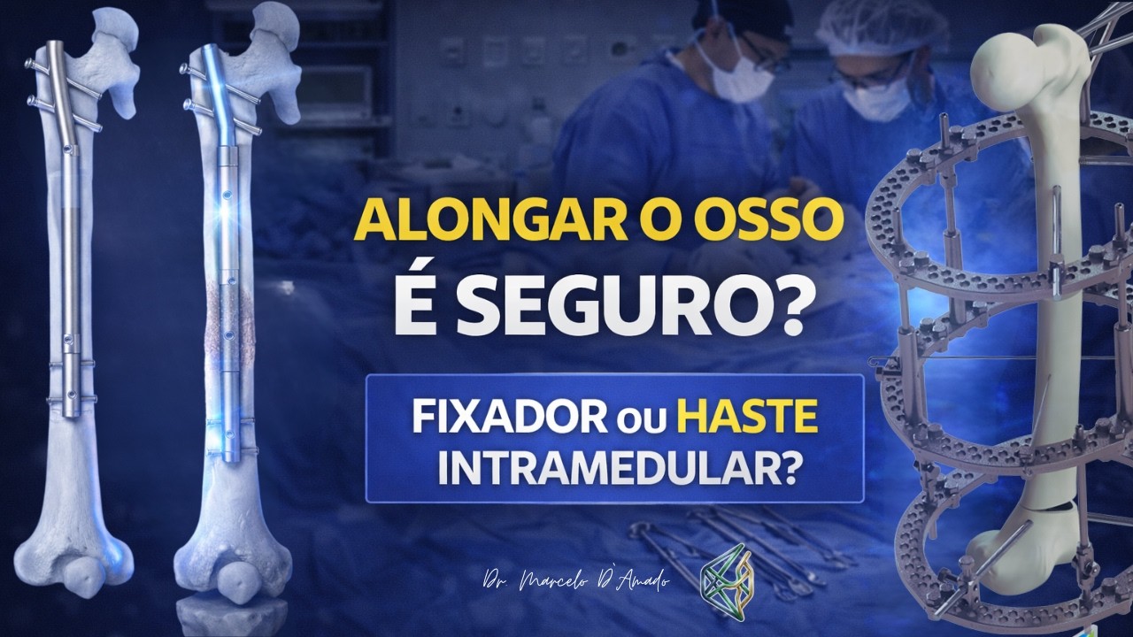 Como alongar os ossos? Técnicas e implantes disponíveis