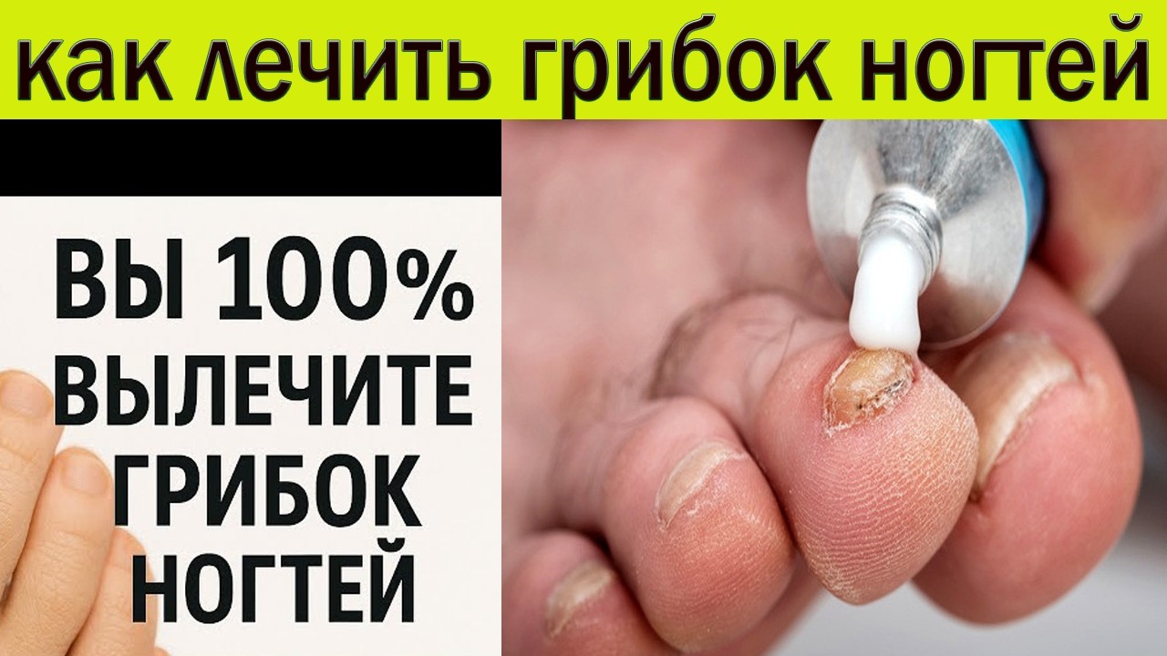 Как лечить грибок ногтей. 100% результат.
