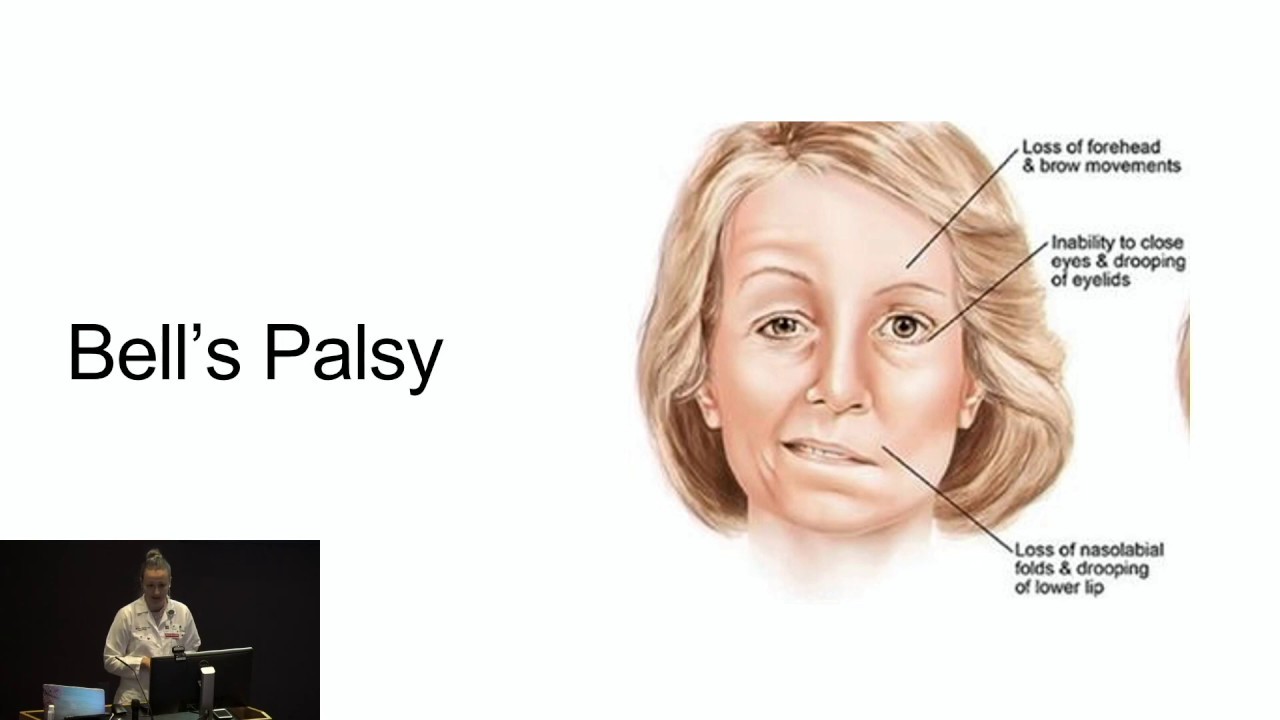 Bell's Palsy, Post Herpetic Neuralgia and Neuropathy 6/3/20