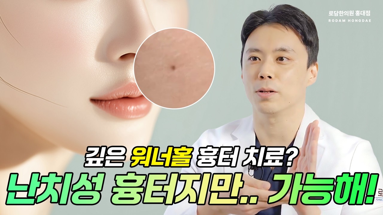 위너홀 흉터 치료 찾고있어? 피지 압출 후 생긴 건 흉터의 깊이가 꽤 깊어! #새살침 #패인흉터 #흉터치료 #흉지사