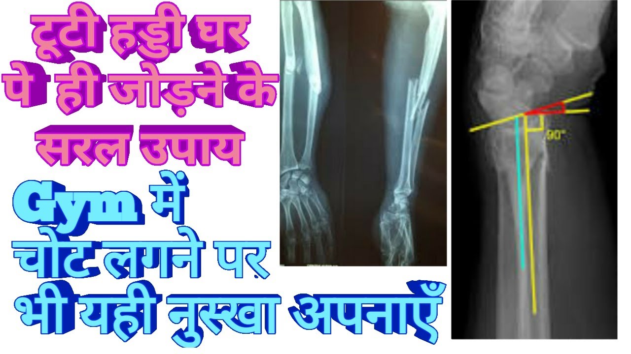 टूटी हड्डी घर  पे ही जोड़ने के सरल उपाय,   Gym में  चोट लगने पे भी यही नुस्खा अपनाएँ, Dr Shalini