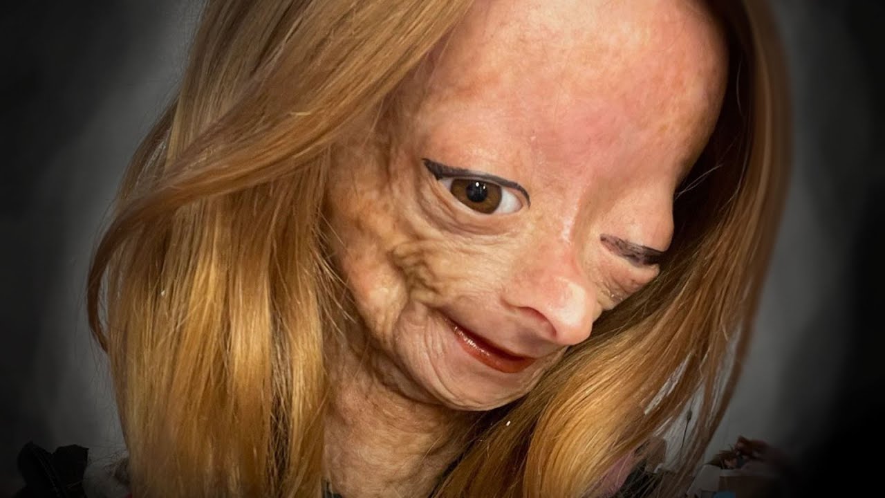 Adalia Rose, YouTube Star With Rare Disorder, Dead at 15
