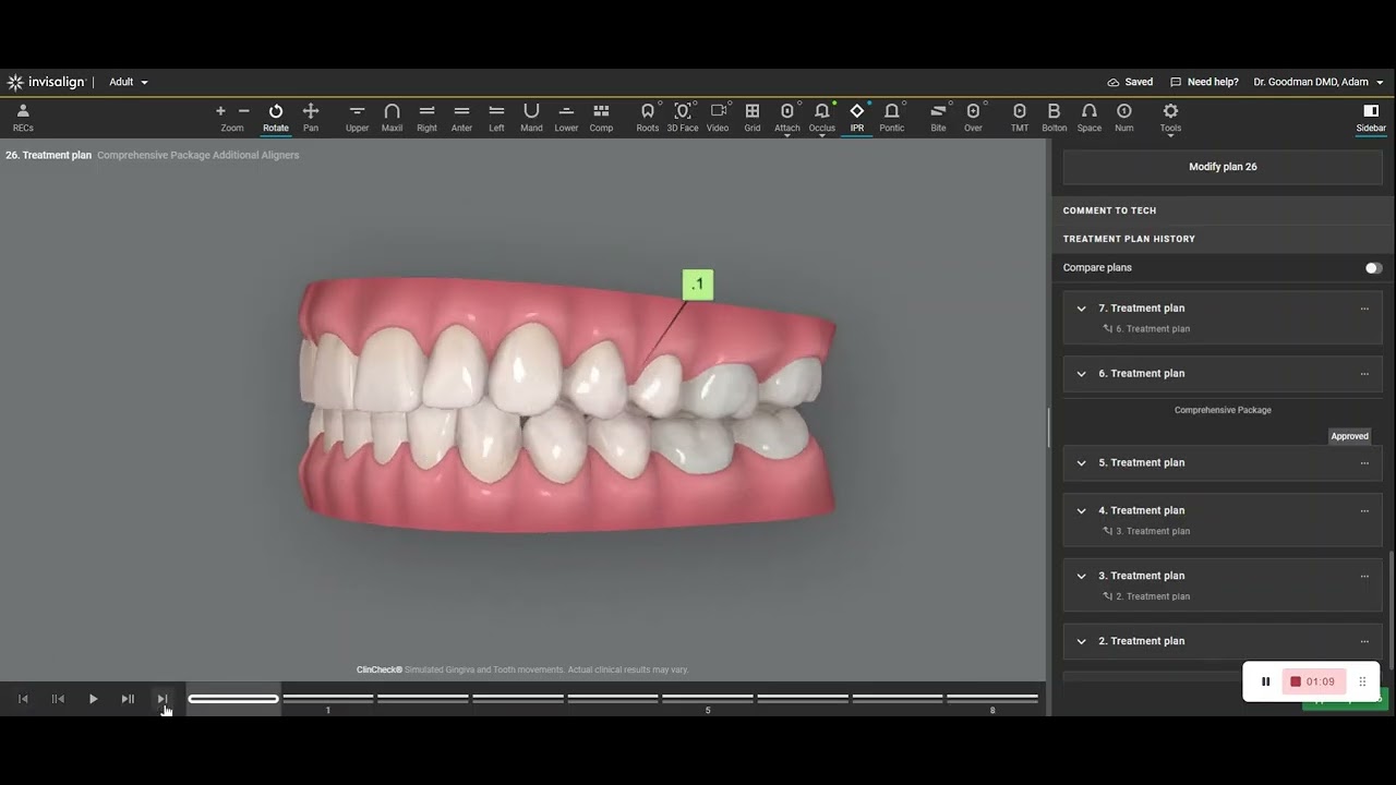 Proclination of Upper Anterior Teeth with Root Apex as the Fulcrum, Eliminating Palatal Root Torque