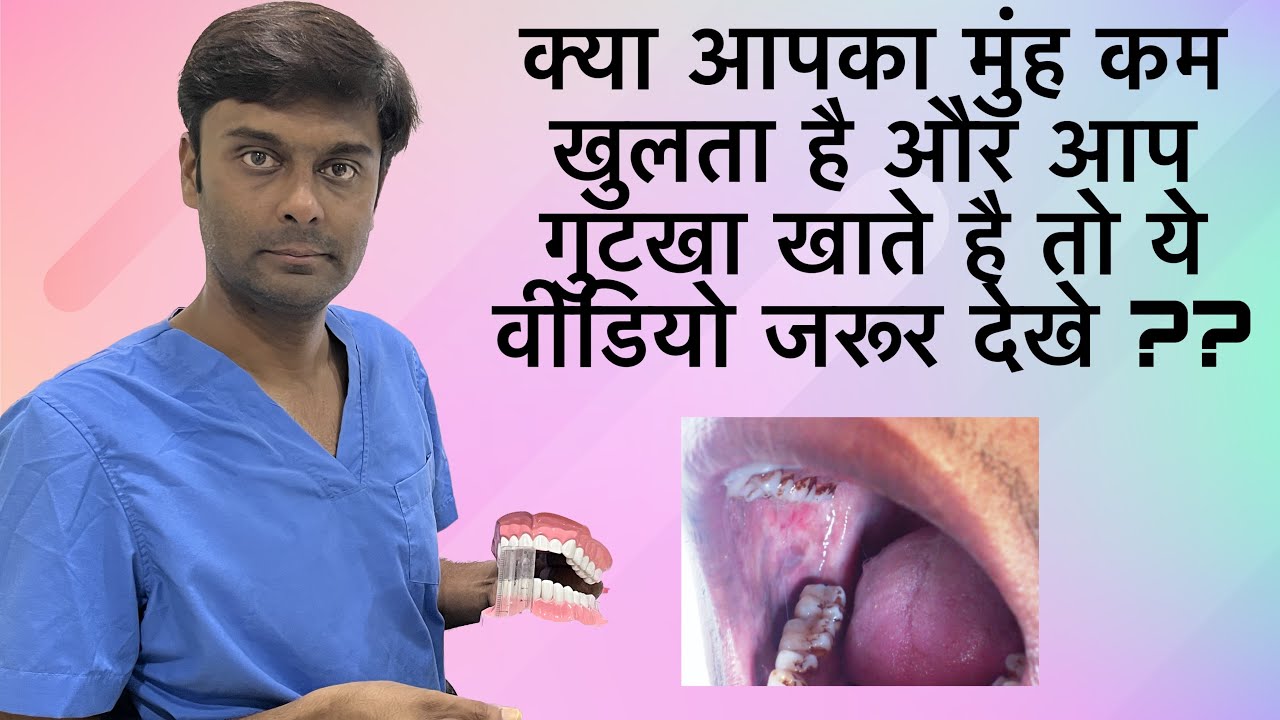 क्या आपका मुंह कम खुलता है और आप गुटखा खाते है तो ये वीडियो जरूर देखे ??🥶😨😷
