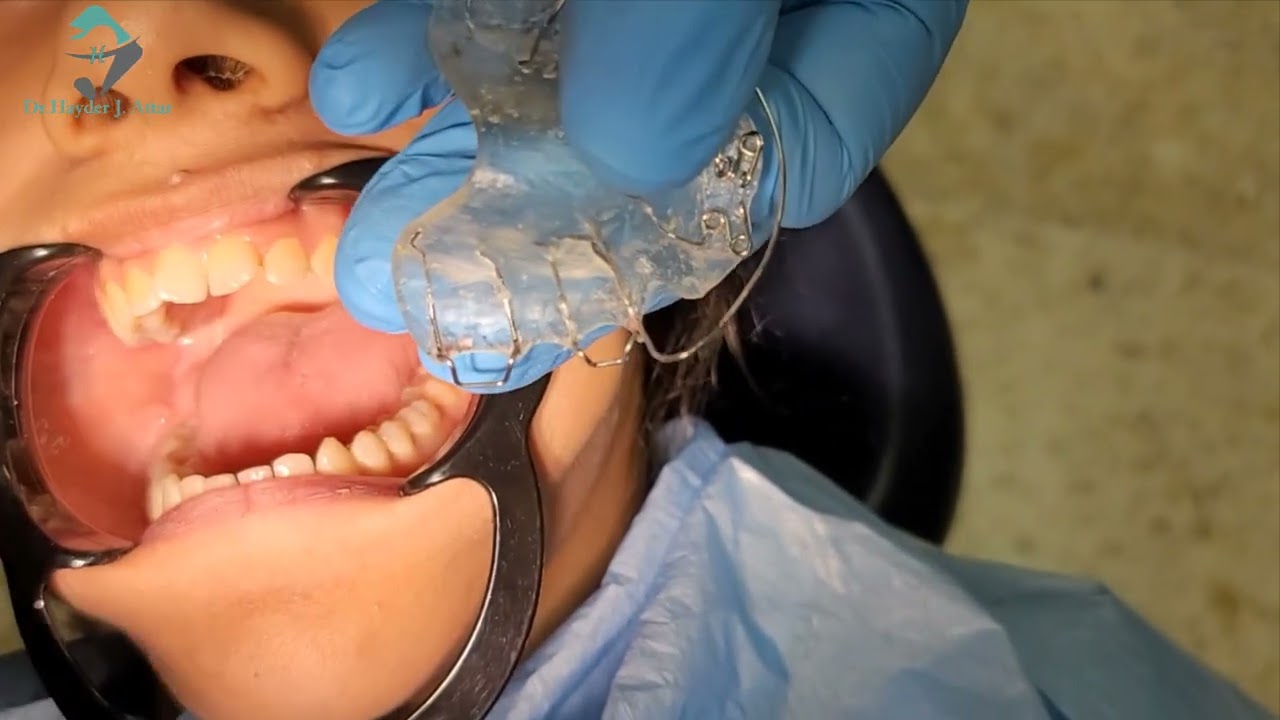 Orthodontic removable sppliance insertion