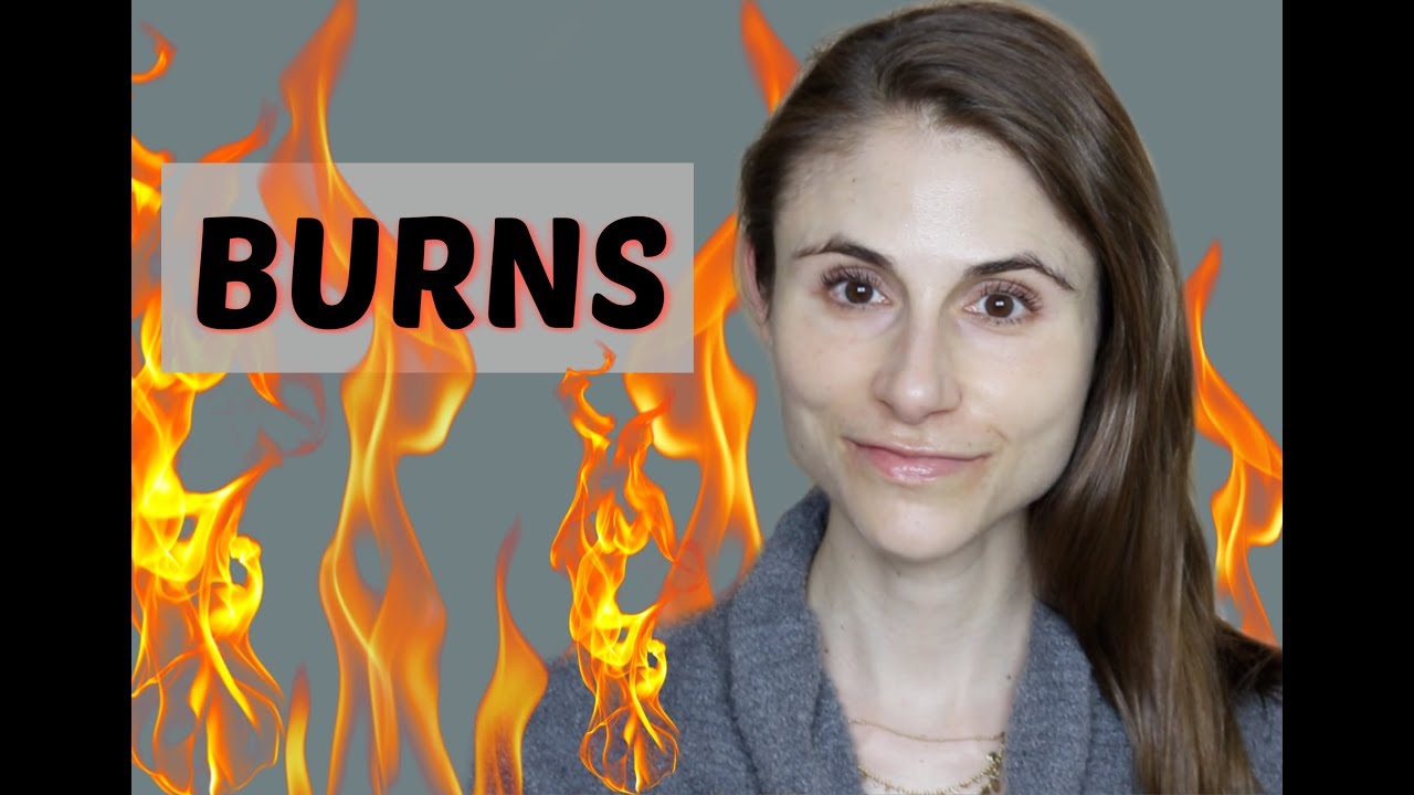 FIRST DEGREE BURNS: TIPS FOR TAKING CARE OF A BURN| DR DRAY