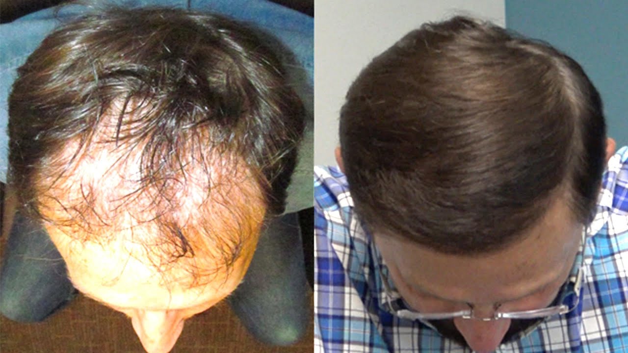Hair Restoration Specialists of Atlanta