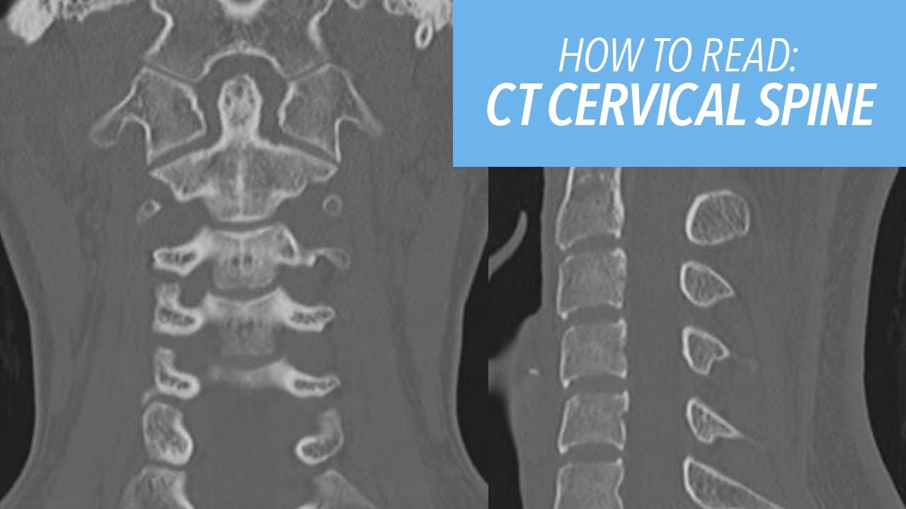 How to Read a CT of the Cervical Spine for Beginners