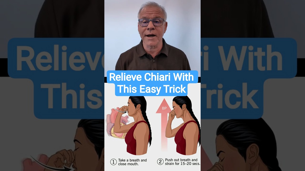 A Simple Physical Therapy Hack for Chiari Patients! #craniocervicalinstability #chiari