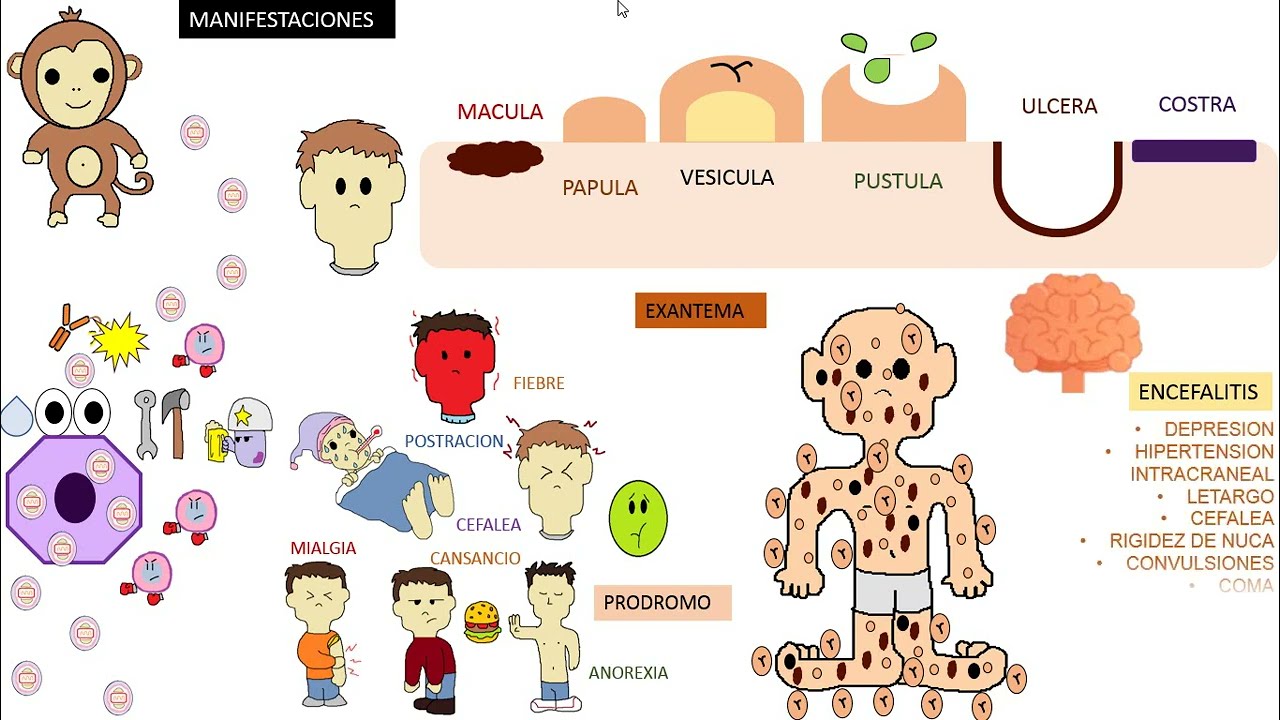 VIRUELA DEL MONO  MPOX