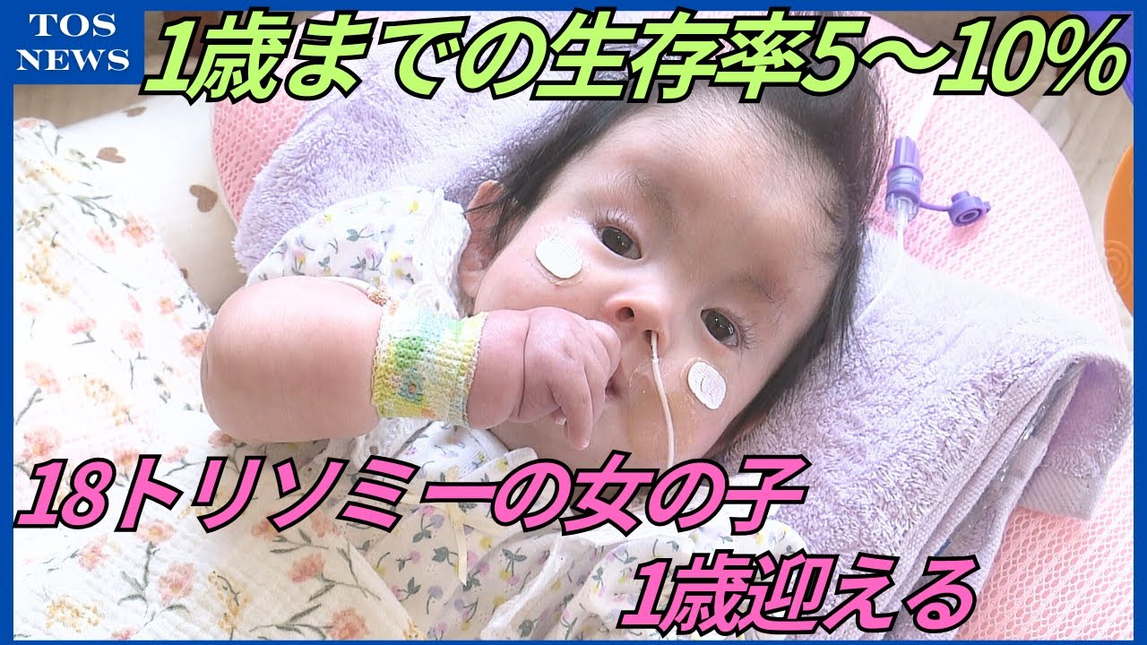 1歳までの生存率約10％　18トリソミーの女の子　家族の支えの中、1歳迎える「一緒に1日でも長く」