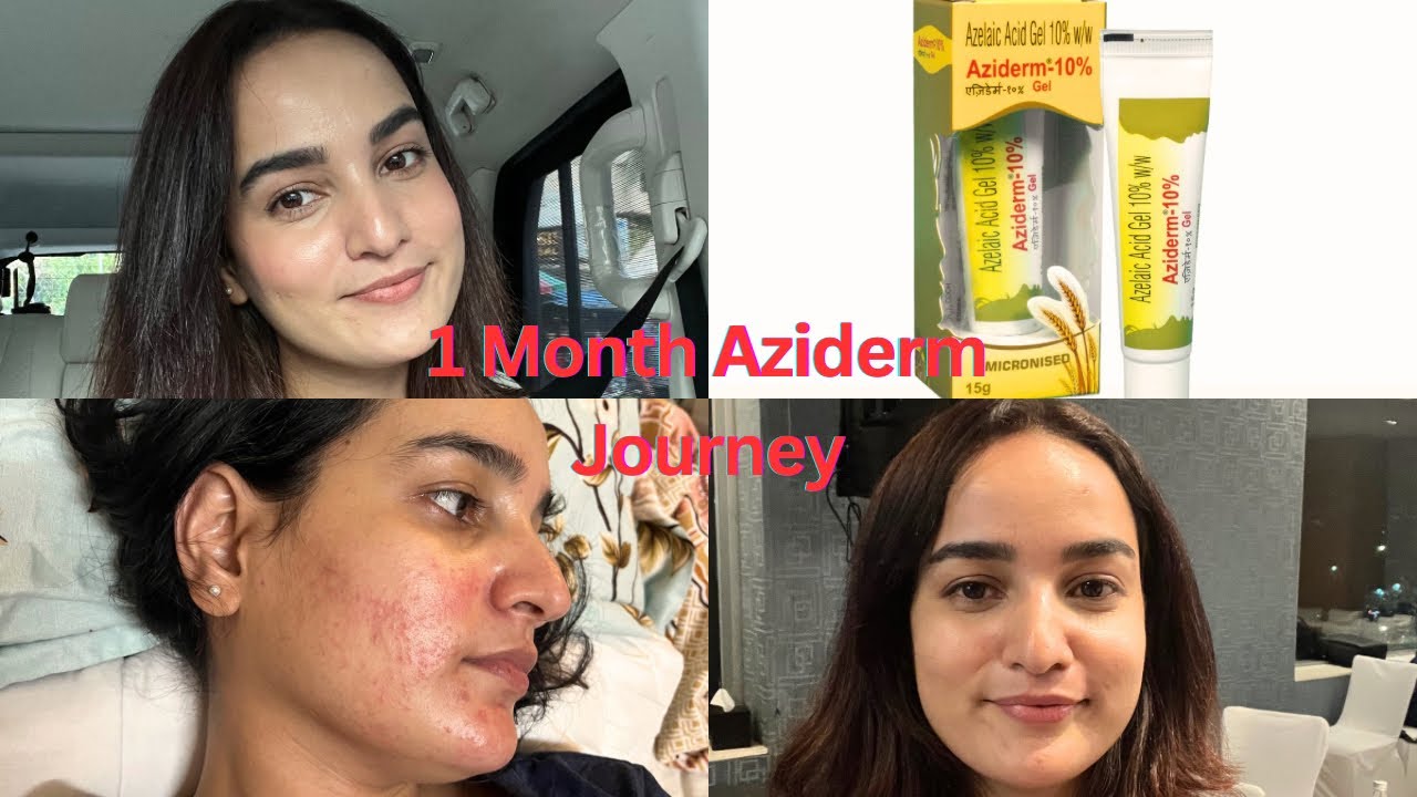 1 Month Aziderm 10% Journey✨