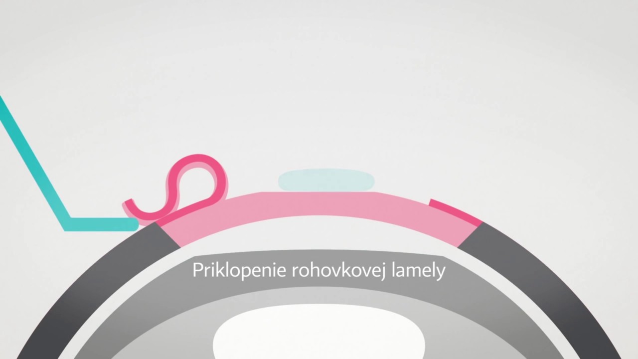 Femtolasik 6D HD | priebeh operácie